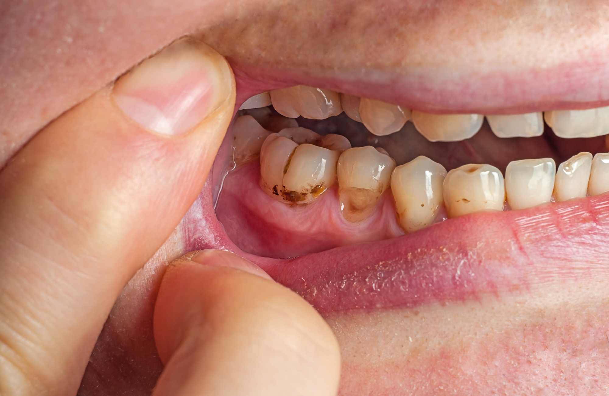 虫歯・歯周病治療